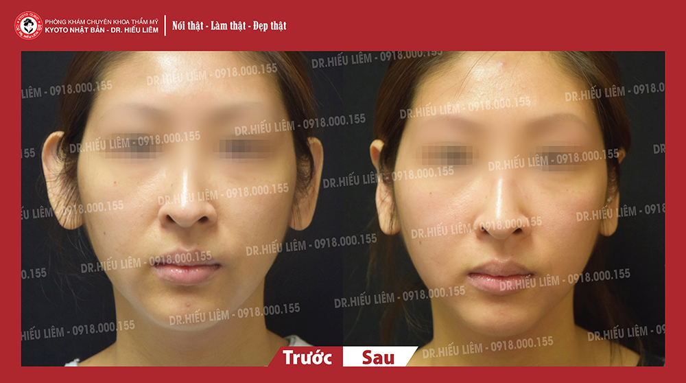 Khách hàng nam chỉnh hình tai vểnh