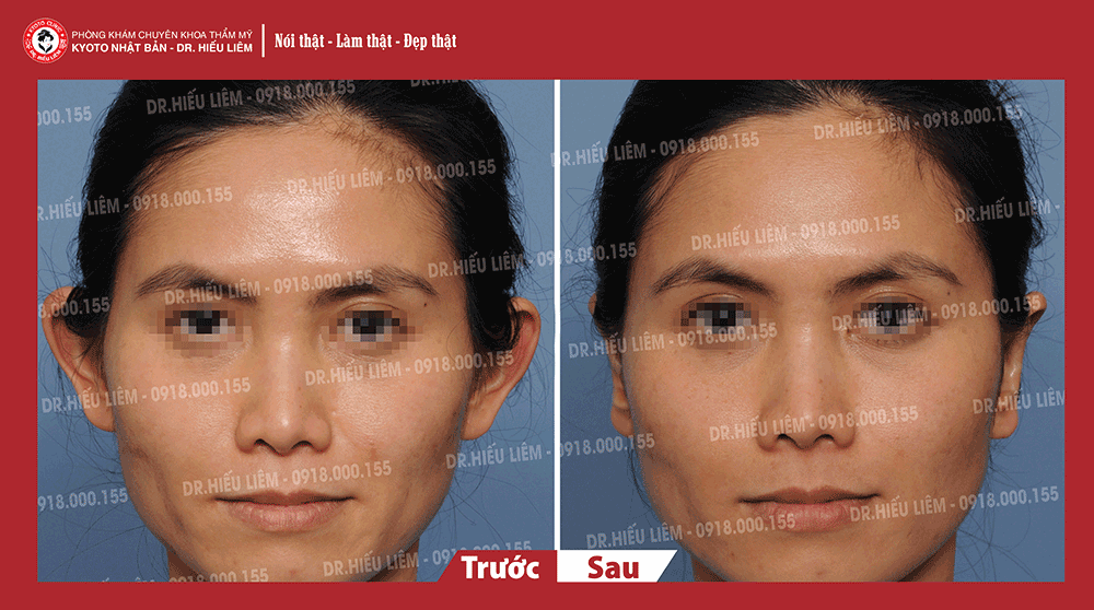 Quy trình chỉnh hình tai vểnh