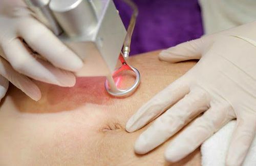 Sử dụng liệu pháp laser CO2 trong điều trị rạn da