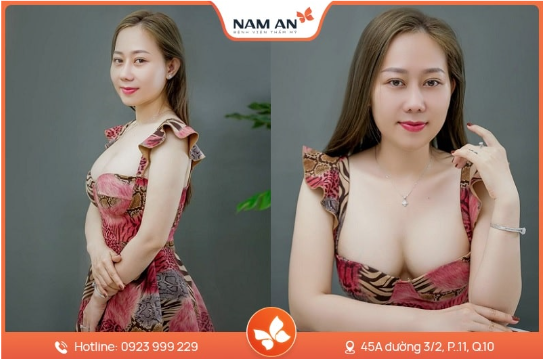 Nâng Ngực Bằng Mỡ Tự Thân Có Bền Không Giữ Được Lâu Không (7)