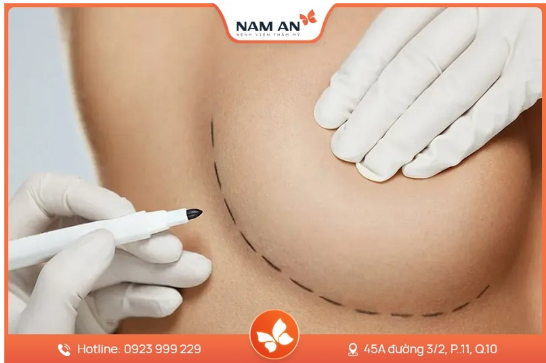 Nâng Ngực Bằng Mỡ Tự Thân Có Bền Không Giữ Được Lâu Không (5)