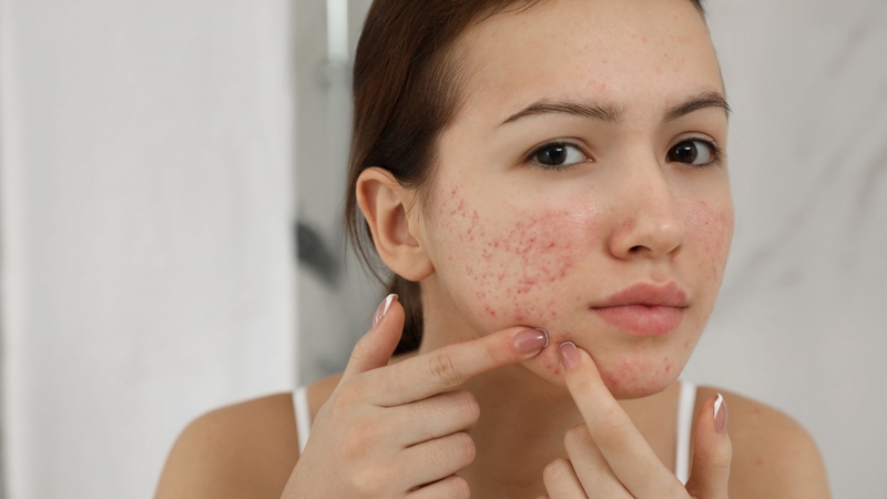 Dùng BHA có trị thâm mụn không?