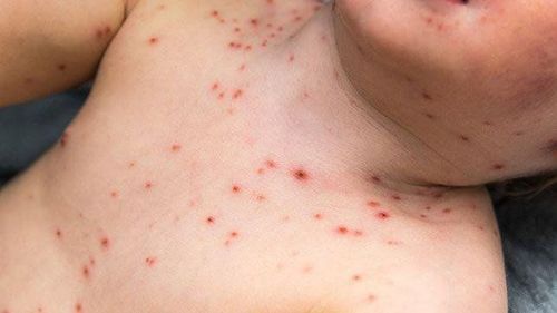 Biến chứng của bệnh thủy đậu