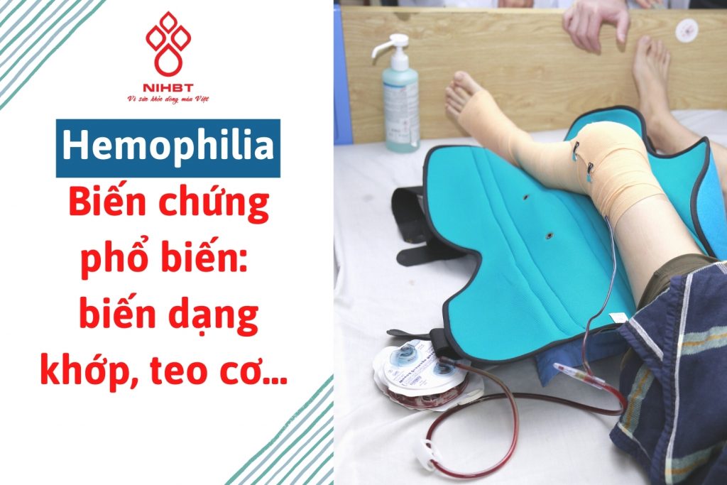 Bệnh máu khó đông (Hemophilia) là gì và cách điều trị