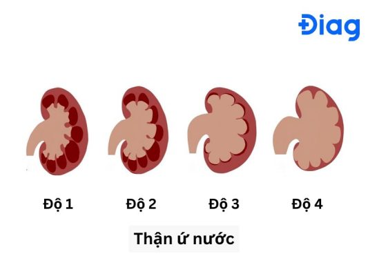 Giãn thận độ 4: Triệu chứng, biến chứng và hướng điều trị