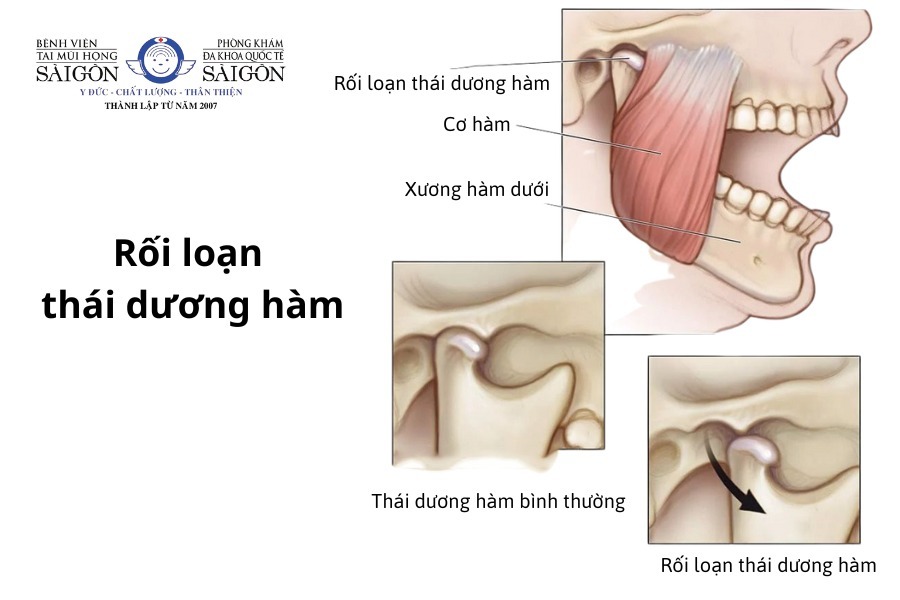 Đau xương hàm là dấu hiệu của bệnh gì? Nguyên nhân và cách điều trị