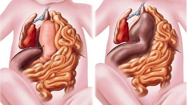 Thoát vị hoành thai nhi là gì? Dấu hiệu, nguyên nhân, chẩn đoán, cách điều trị và phòng bệnh