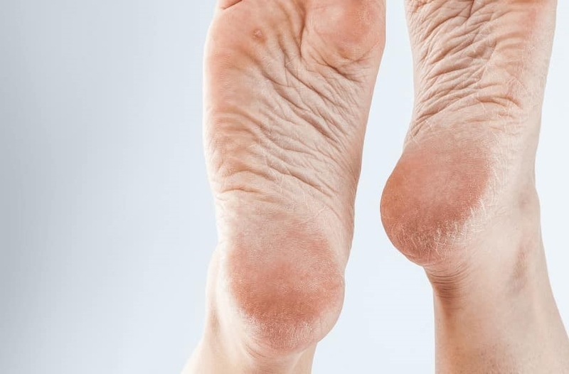 Bạn đã biết 4 loại kem trị nứt gót chân hiệu quả này chưa?