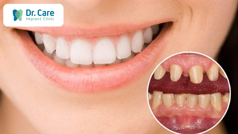 7 Nhược điểm của bọc răng sứ - Lời khuyên từ chuyên gia
