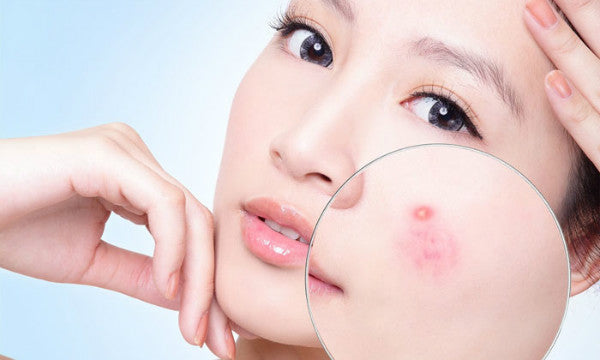 nguyên nhân da khô mụn, nguyên nhân gây ra tình trạng da khô mụn