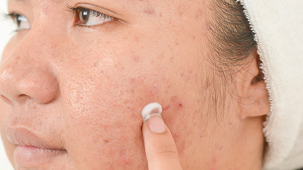 cách chọn sản phẩm dành cho da khô mụn, cách chọn sản phẩm chăm sóc da khô mụn