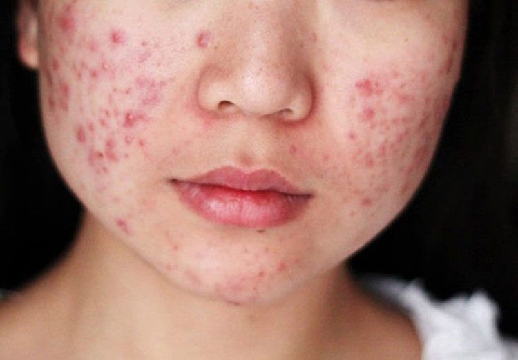 Thức khuya gây nổi mụn trứng cá